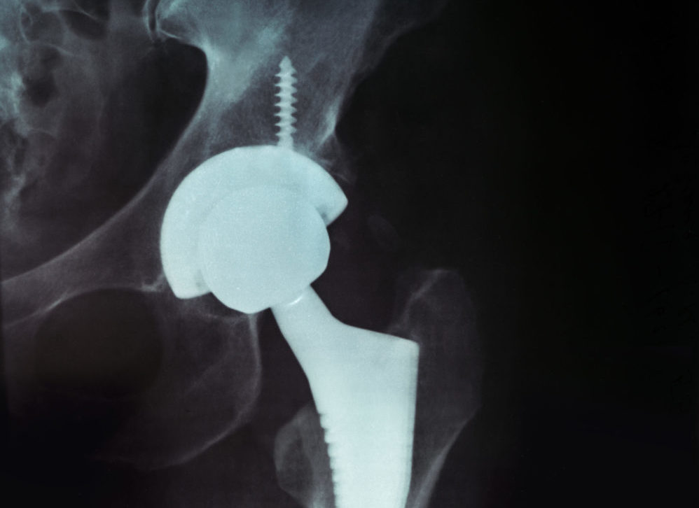 X-ray of the pelvis Endoprosthesis